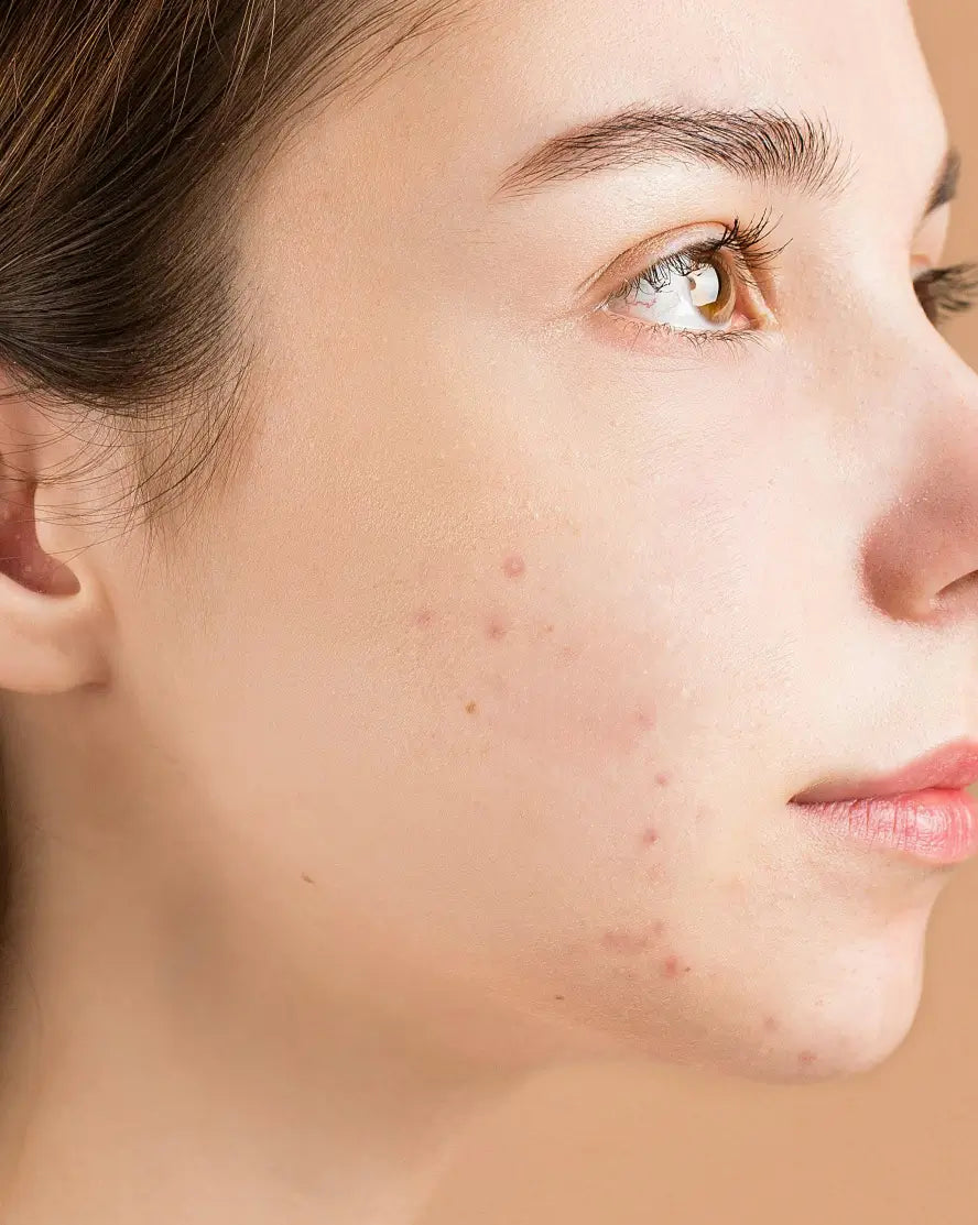 Blemish-prone skin
